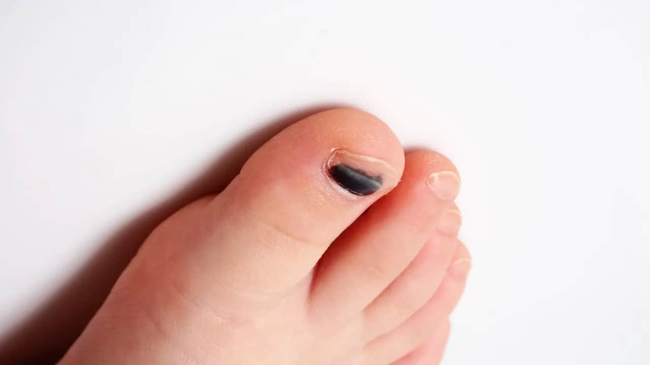 Krwiak pod paznokciem: Zejdzie sam czy trzeba do specjalisty?