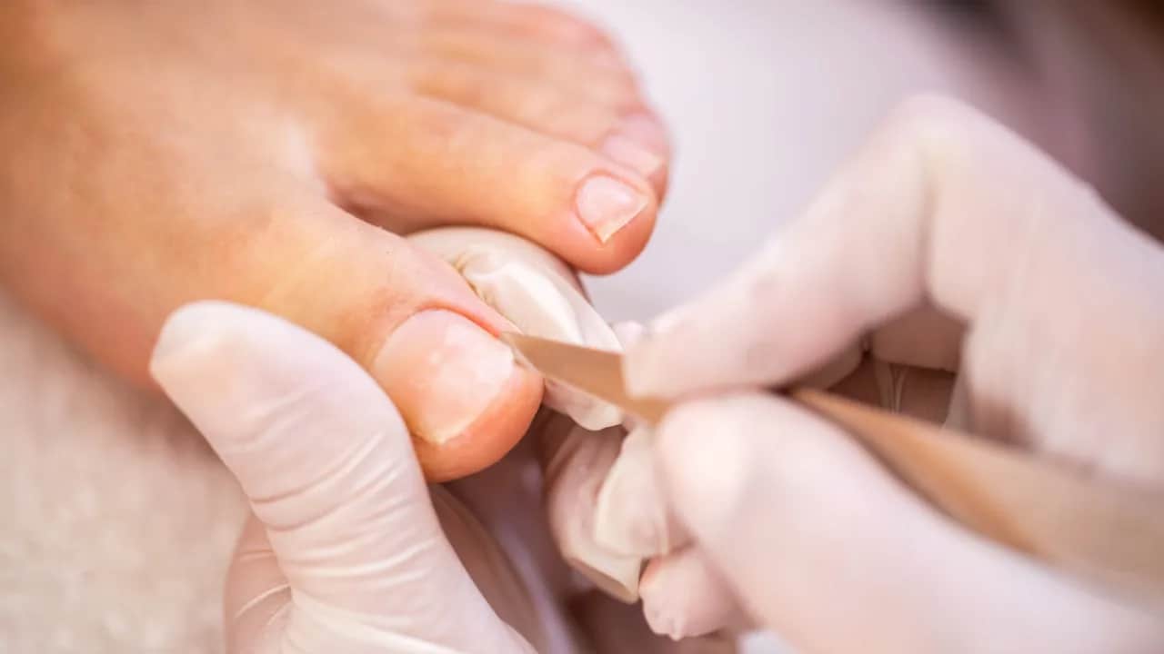 Wrastający paznokieć: Domowe leczenie i kiedy szukać pomocy eksperta?