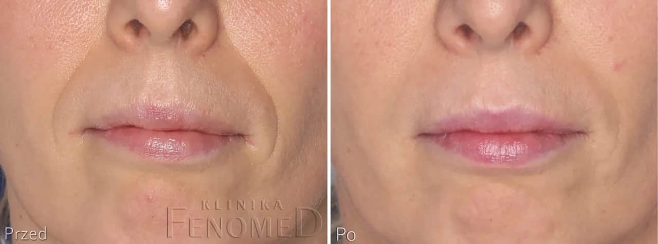 1 ml kwasu hialuronowego: Co naprawdę zmieni w Twojej twarzy?